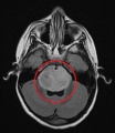 521px-Tumor BrainstemGlioma1.JPG